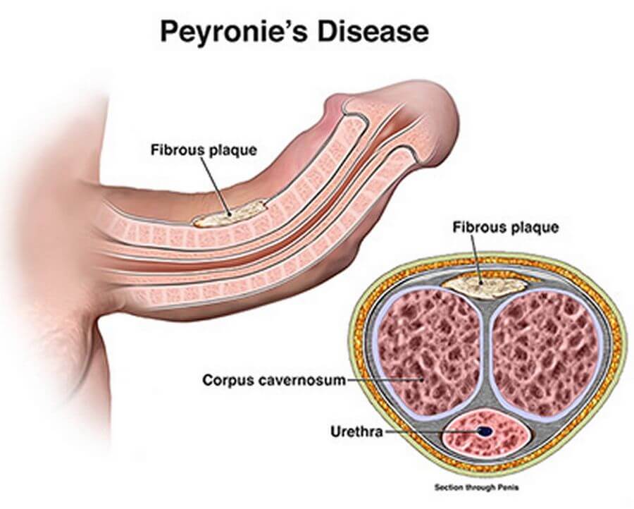 Peyronie’s disease